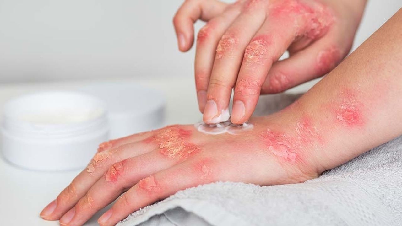 hidrokortizon kremi yüzde 1