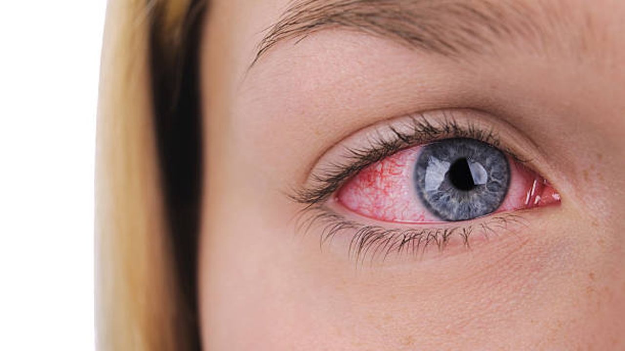 Göz kanlanmasının ardındaki gizemli nedenleri: Sağlığınız için bilmeniz gerekenler!