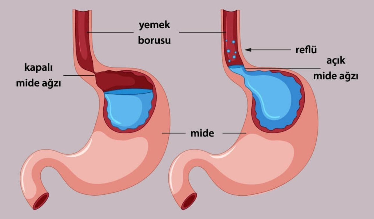 Reflü Reflü nedir, belirtileri nelerdir? Reflüye ne iyi gelir? Ramazan öncesi ...